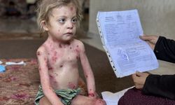 Gazze'de Kelebek Hastası Küçük Nur, Umutla Tedavi Günlerini Bekliyor