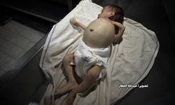 Gazze’de açlıktan şehit olanların sayısı 399’a yükseldi