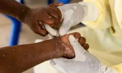 DSÖ: M Çiçeği Virüsünün Yeni ve Daha Şiddetli Türü Yayılıyor