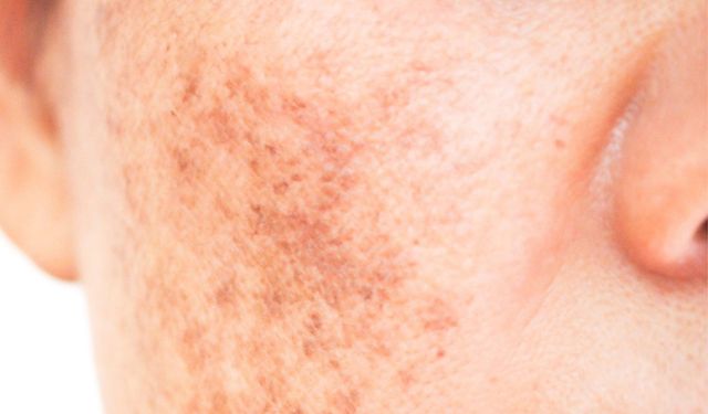 Güneş Lekesi Geçiren Yöntemler ve Püf Noktaları