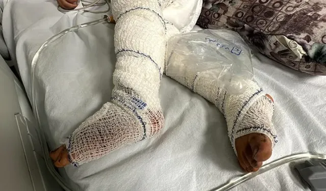 Gazze'deki Yanık Hastaları İçin Durum Çığırından Çıkmış: MSF Acil Yardım Çağrısı Yapıyor.