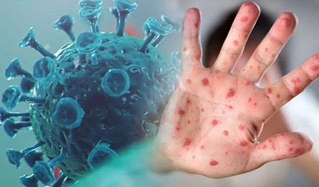 Mpox Virüsü İnsanlar Arasında Hızla Yayılabilir: Yeni Tehdit Kapıda mı?
