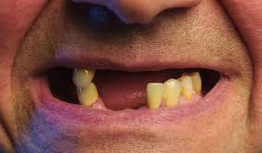 Diş Kaybı Tarih Oluyor: Bilim İnsanları Doğal Dişlerin Yeniden Çıkmasını Sağlayan İlaç Geliştirdi!